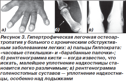 Диета При Заболевании Барабанные Палочки