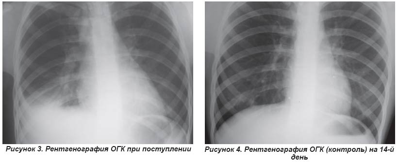 Реферат: Пневмония в правой нижней доле