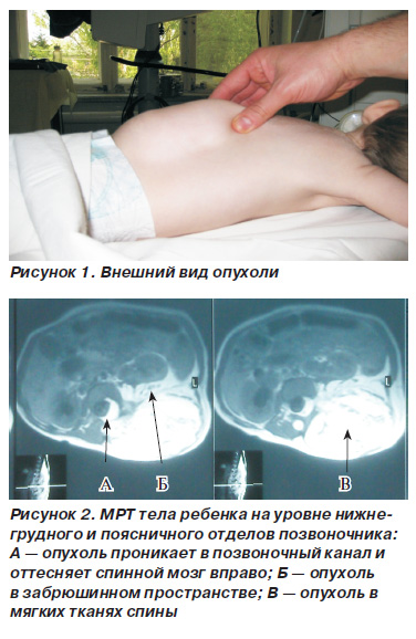 липома в теле позвонка