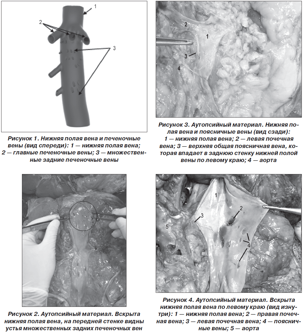 Нижняя Полая Вена Фото