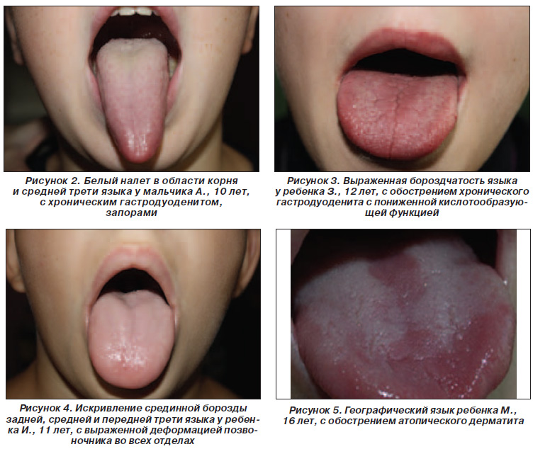 Фото Болезней Языка Человека