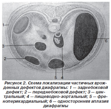 Диафрагмальная грыжа чем опасна