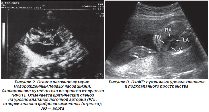Реферат: Недостаточность клапанов и сужение отверстия легочной артерии