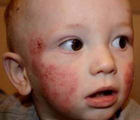 Результаты терапии атопического дерматита у детей с использованием препарата левоцетиризина гидрохлорид  