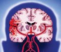 Какой ингибитор АПФ назначить для вторичной профилактики инсульта?