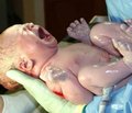 Клиническое наблюдение ребенка c врожденной гиперплазией коры надпочечниковых желез