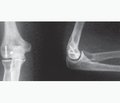 Лікування ізольованих переломів  capitulum humeri в дорослих пацієнтів  із застосуванням мікрогвинтів