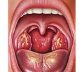 The adenoids hyperplasia and adenotomy effects on the children’s immunity and health