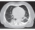 About the role of Ureaplasma and Mycoplasma infection in the development of bronchopulmonary dysplasia in infants