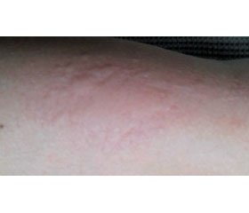 Chronic urticaria in children:  clinical manifestation and current therapeutic approaches — a case study