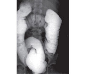The problem of gastroptosis as a manifestation of undifferentiated connective tissue dysplasia  in the clinical practice of pediatric gastroenterologist