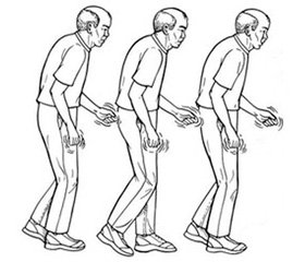 Провоцирующие факторы дебюта моторных симптомов болезни Паркинсона
