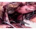 The experience of surgical treatment of hiatal hernia with laparoscopic access