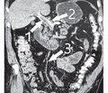 Clinical case of successful conservative treatment of the portal and superior mesenteric vein thrombosis