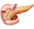 Liquid and volemic disorders in patients with different forms of acute pancreatitis  after initiation of infusion therapy