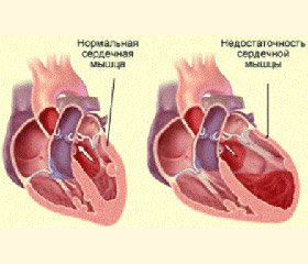 Когнітивна дисфункція у пацієнтів  з хронічною серцевою недостатністю  та зниженою фракцією викиду лівого шлуночка  на фоні гіпертонічної хвороби