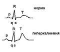 Менеджмент гіперкаліємії в дітей із хронічною хворобою нирок