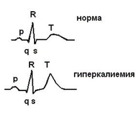 Менеджмент гіперкаліємії в дітей  із хронічною хворобою нирок