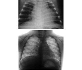 The risk prediction of acute simple bronchitis’ prolonged duration in children
