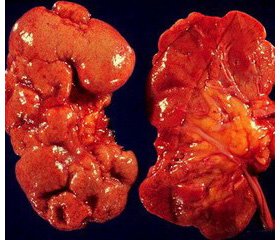 Immune system features in pediatric candidates  for kidney transplantation