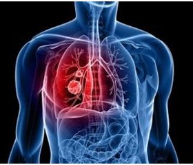 Predicting the risk of chronic bronchitis in teenage smokers