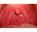 Клінічний досвід застосування Streptococcus salivarius K12 у профілактиці фаринготонзилітів і респіраторних інфекцій у дітей