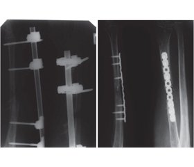Кісткова пластика в системі спеціалізованого лікування поранених з бойовими  травмами кінцівок