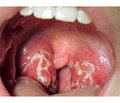Клініко-імунологічна ефективність використання Streptococcus salivarius K12 в профілактиці загострень і лікуванні хронічного тонзиліту в дітей