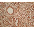 The role of epithelial-mesenchymal transition in sclerotic changes in the kidneys, ureters and bladder of fetuses  and newborns from mothers, whose pregnancy was complicated by preeclampsia of varying severity