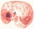 Медотилин в лечении постинсультных когнитивных нарушений
