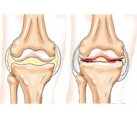 Комбіновані хондропротектори при лікуванні остеоартриту