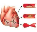 Combination therapy of ischemic heart disease using Armadin and Trizipin — another option or a unique opportunity?