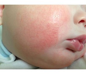 Efficiency of allergen specific immunotherapy in children with atopic dermatitis combined  with the pathology of the upper gastrointestinal tract