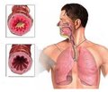 Causes of dry cough in children and approaches to the therapy