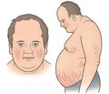 Оценка качества жизни больных с синдромом Кушинга при хирургическом и консервативном лечении