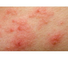 Features of atopic dermatitis in children with oxalic acid dysmetabolism