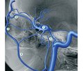 Клінічний випадок ендоваскулярного виключення дурального каротидно-кавернозного співустя трансвенозним трансорбітальним доступом