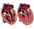Improving the diagnosis of diastolic dysfunction of heart ventricles in newborns by tissue Doppler imaging