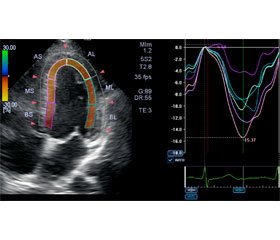 Оцінка деформації лівих відділів серця у хворих із гіпертонічною хворобою методом спекл-трекінгехокардіографії
