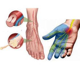 Диабетическая полинейропатия: современные принципы лечения