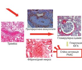Склеродермічна ниркова криза:  питання патогенезу, клініка та сучасні підходи  до лікування
