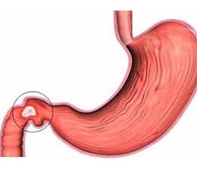 Інфекція Helicobacter pylori: асоціація факторів вірулентності з антигенами HLA-системи ІІ класу (локус DQ A1) у дітей, хворих на виразку дванадцятипалої кишки