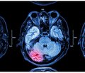 Clinical and neurological features of the vascular pathology of the brain in military personnel evacuated from the zone of Joint Forces Operation