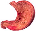 The distribution of HLA- system antigens in children with peptic ulcer