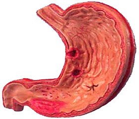 The distribution of HLA- system antigens in children with peptic ulcer