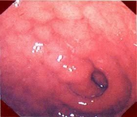 Endoscpopic characteristics of upper digestive system in children with allergic diseases