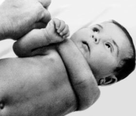 Гигантская киста селезенки у ребенка с хроническим лейкозом