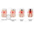 Как лечить кариес зубов