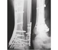 Закритий малоінвазивний остеосинтез епіметафізарних переломів дистального відділу кісток гомілки