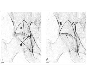 Систематизация рентгенморфометрических характеристик вертлужной области при асептическом некрозе головки бедренной кости